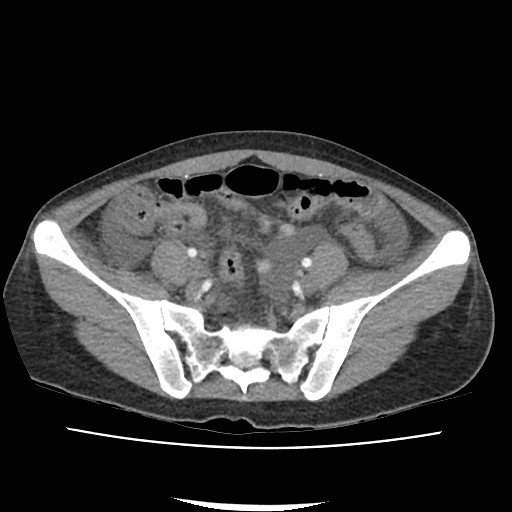 Acute myocarditis (Radiopaedia 55988-62613 Axial C+ portal venous phase 58).jpg