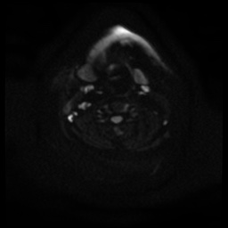 Acute otitis externa (Radiopaedia 57296-64236 Axial DWI 21).jpg