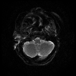 Acute otitis externa (Radiopaedia 57296-64236 Axial DWI 37).jpg