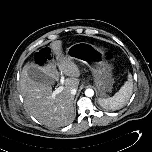 File:Acute pancreatic necrosis (Radiopaedia 13560-13486 Axial C+ portal venous phase 36).jpg
