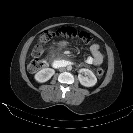 File:Acute pancreatitis (Radiopaedia 20829-20744 Axial C+ portal venous phase 24).jpg