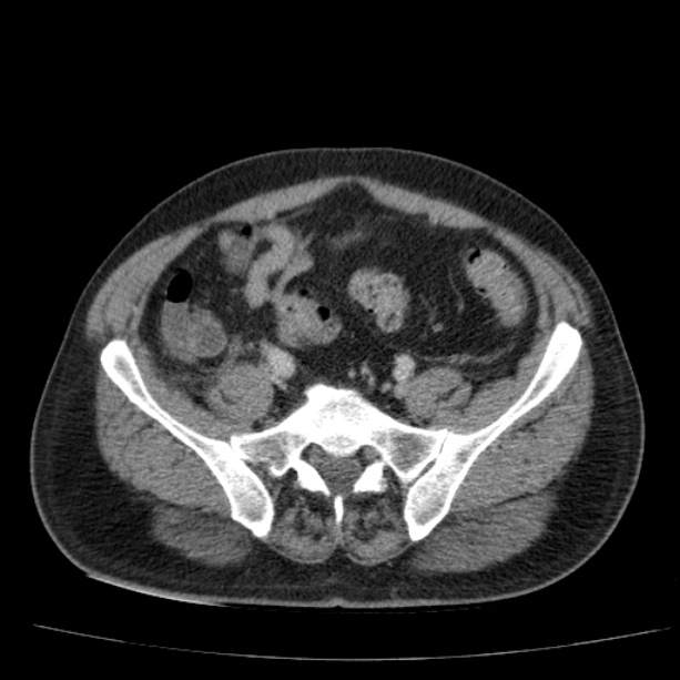 Acute pancreatitis (Radiopaedia 26663-26813 Axial C+ portal venous phase 65).jpg