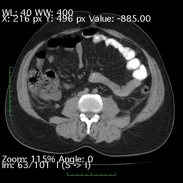 Acute pancreatitis (Radiopaedia 34043-35276 Axial non-contrast 63).jpg