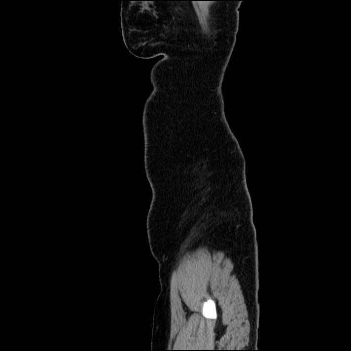 Acute pancreatitis (Radiopaedia 69236-79012 Sagittal C+ portal venous phase 13).jpg