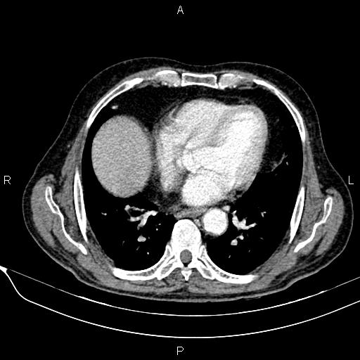 File:Acute pancreatitis (Radiopaedia 85146-100701 Axial C+ arterial phase 16).jpg