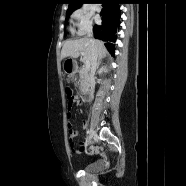 Acute pancreatitis - Balthazar C (Radiopaedia 26569-26714 Sagittal C+ portal venous phase 30).jpg