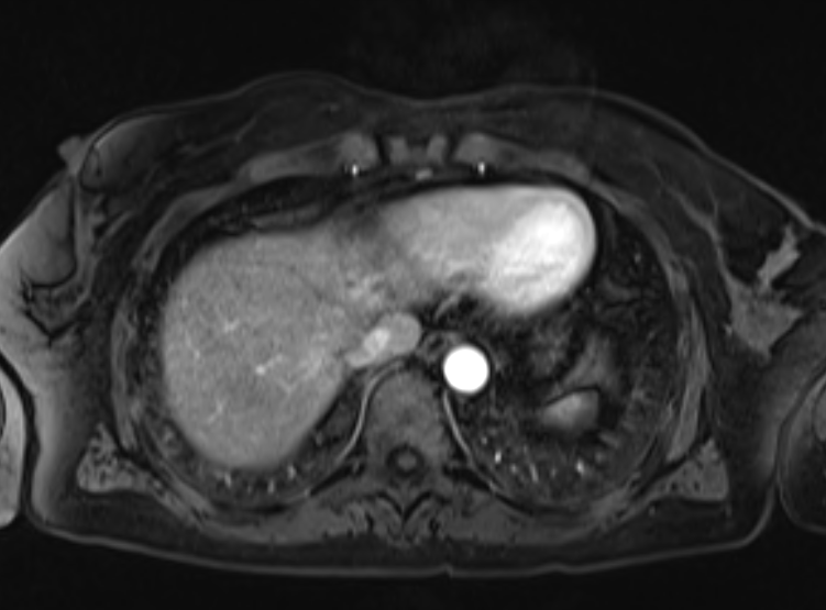 Acute pancreatitis - Balthazar E - post ERCP (Radiopaedia 27562-27778 Axial VIBE C+ 14).png