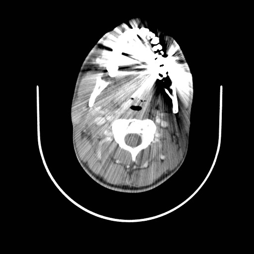 File:Acute submandibular sialadenitis secondary to ductal stone (Radiopaedia 27999-28267 Axial C+ delayed 17).jpg