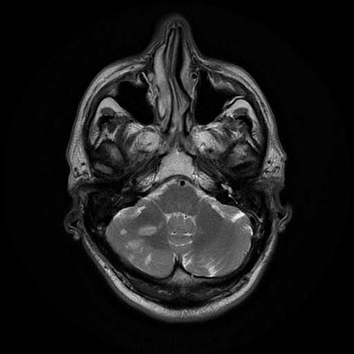 File:Acute superior cerebellar artery territory infarct (Radiopaedia 84104-99358 Axial T2 26).jpg