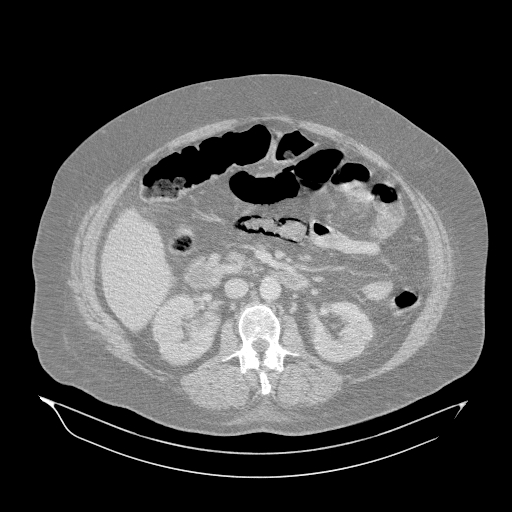 Acute superior mesenteric artery occlusion (Radiopaedia 51288-56960 Axial lung window 23).jpg