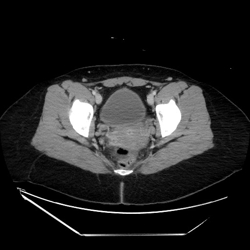 Acute uncomplicated appendicitis (Radiopaedia 73704-84499 Axial C+ portal venous phase 148).jpg