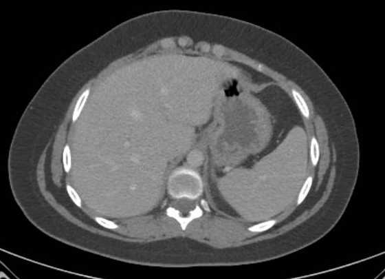 Acute unilateral nonhemorrhagic adrenal infarction (Radiopaedia 67560-76957 Axial renal parenchymal phase 6).jpg