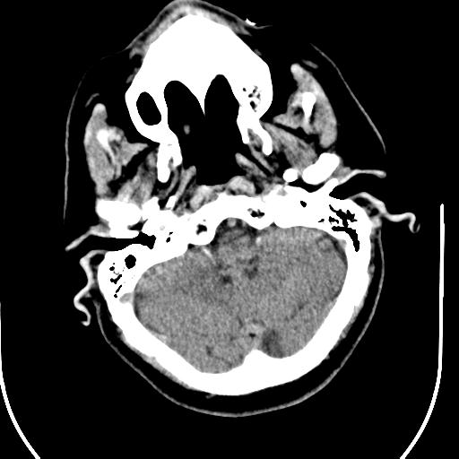 File:Acute vertebrobasilar ischemic infarction (Radiopaedia 25220-25473 Axial non-contrast 13).jpg
