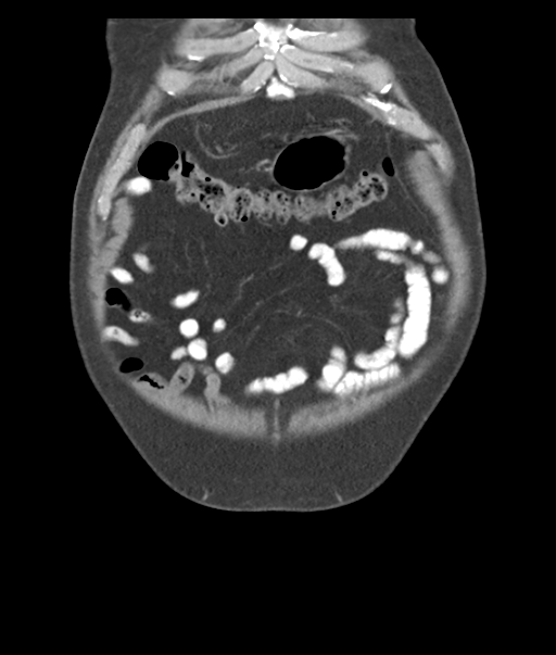 Adenocarcioma of rectum- T1 lesion (Radiopaedia 36921-38547 Coronal C+ portal venous phase 10).png
