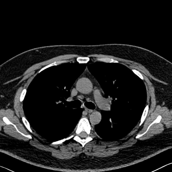 Adenoid cystic carcinoma of the trachea (Radiopaedia 49042-54137 Axial non-contrast 131).jpg