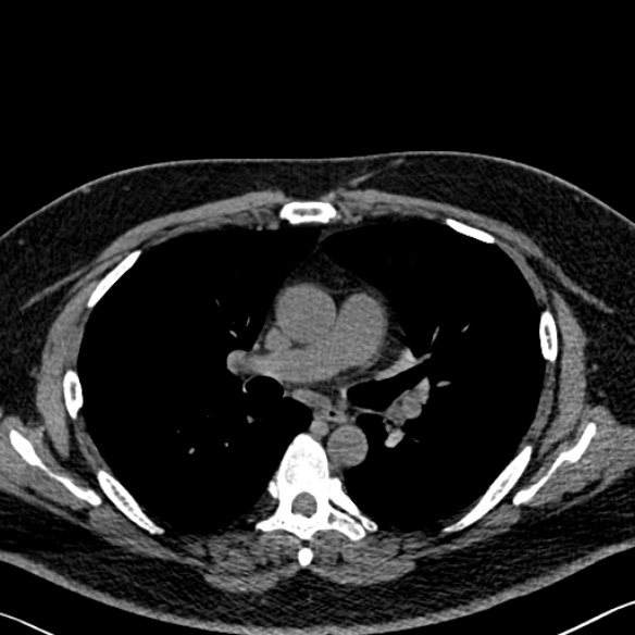 File:Adenoid cystic carcinoma of the trachea (Radiopaedia 49042-54137 Axial non-contrast 155).jpg