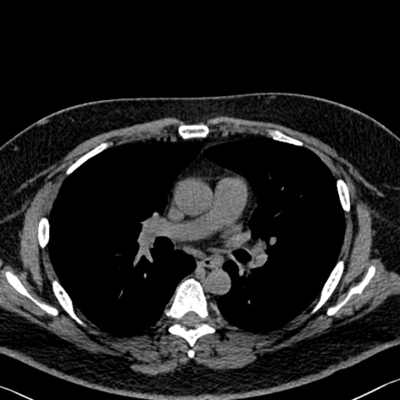 Adenoid cystic carcinoma of the trachea (Radiopaedia 49042-54137 Axial non-contrast 164).jpg