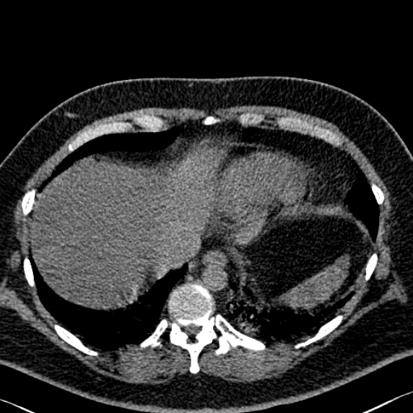 Adenoid cystic carcinoma of the trachea (Radiopaedia 49042-54137 Axial non-contrast 282).jpg