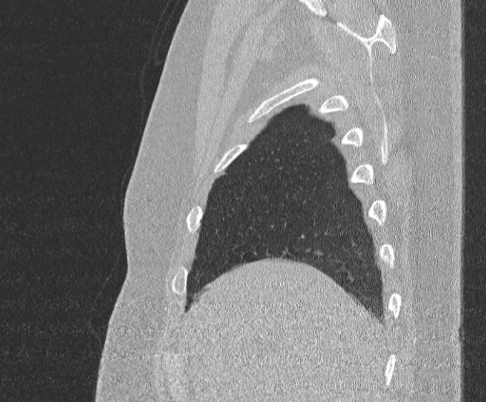 Adenoid cystic carcinoma of the trachea (Radiopaedia 49042-54137 Sagittal lung window 70).jpg