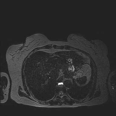 File:Adenomyomatosis of the gallbladder (Radiopaedia 50246).JPEG