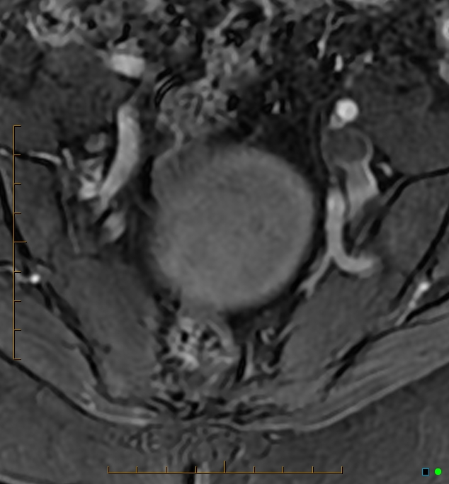 Adenomyosis uterus with hematometra (Radiopaedia 45779-50011 Axial T1 C+ fat sat 5).jpg