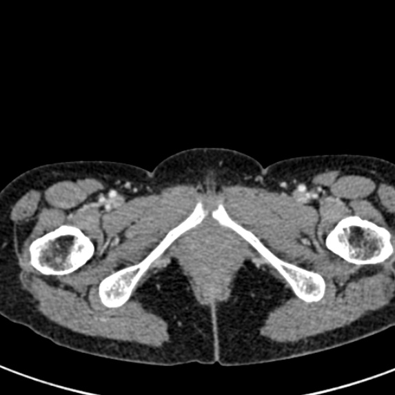 File:Adhesional small bowel obstruction (Radiopaedia 48397-53305 Axial C+ portal venous phase 100).jpg