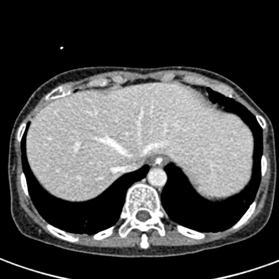 File:Adhesional small bowel obstruction (Radiopaedia 48397-53305 Axial C+ portal venous phase 6).jpg