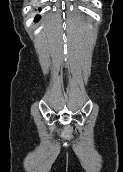 Adhesional small bowel obstruction (Radiopaedia 48397-53305 Coronal C+ portal venous phase 315).jpg