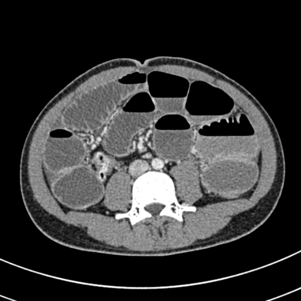 Adhesional small bowel obstruction (Radiopaedia 52107-57980 Axial C+ portal venous phase 71).jpg