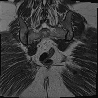 File:Adnexal multilocular cyst (O-RADS US 3- O-RADS MRI 3) (Radiopaedia 87426-103754 Coronal T2 28).jpg
