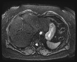 Adrenal cortical carcinoma (Radiopaedia 64017-72770 Axial DWI 2).jpg