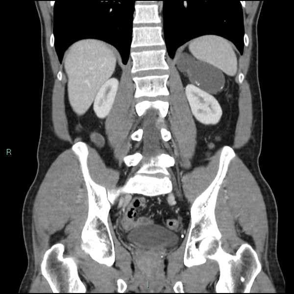 Adrenal cystic lymphangioma (Radiopaedia 83161-97534 Coronal C+ portal venous phase 51).jpg