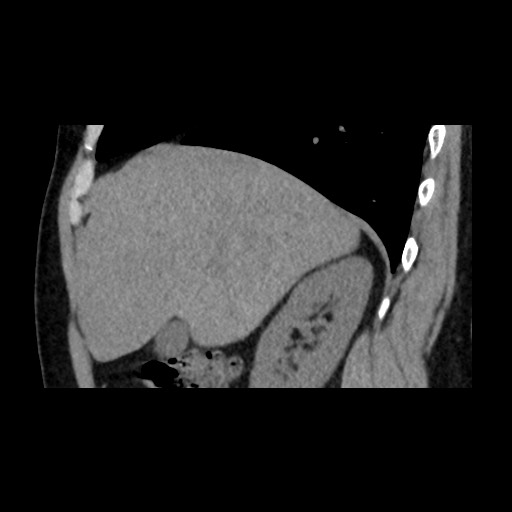 Adrenal gland trauma (Radiopaedia 81351-95079 Sagittal non-contrast 29).jpg
