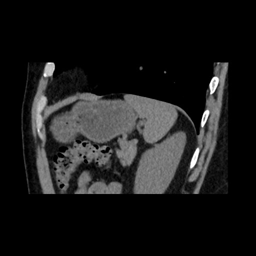 Adrenal gland trauma (Radiopaedia 81351-95079 Sagittal non-contrast 79).jpg