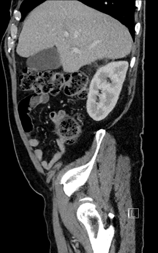 Adrenal lymphoma (Radiopaedia 73730-84529 Sagittal C+ portal venous phase 27).jpg