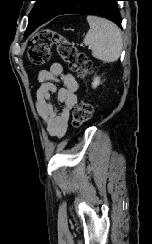 Adrenal lymphoma (Radiopaedia 73730-84529 Sagittal C+ portal venous phase 94).jpg