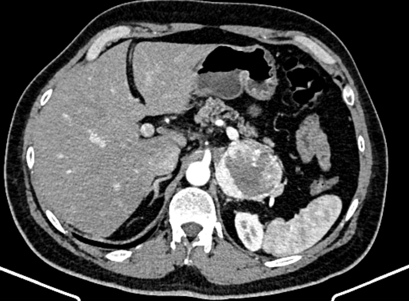 Adrenal metastases (Radiopaedia 73082-83791 Axial C+ arterial phase 43).jpg