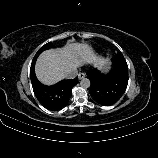 Adrenal myelolipoma (Radiopaedia 82742-96986 Axial non-contrast 7).jpg