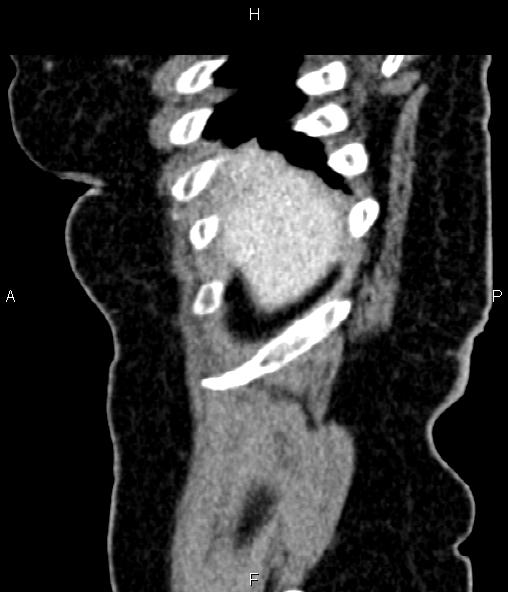Adrenal myelolipoma (Radiopaedia 82742-96986 Sagittal renal cortical phase 16).jpg