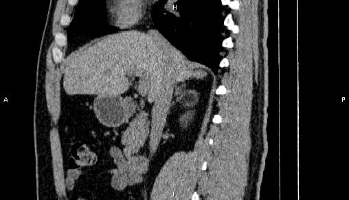Adrenal myelolipoma (Radiopaedia 84321-99619 Sagittal non-contrast 44).jpg