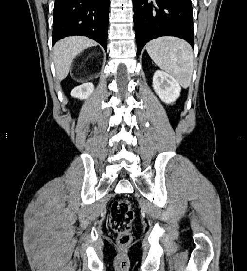 File:Adrenal myelolipoma (Radiopaedia 87794-104246 Coronal renal cortical phase 51).jpg