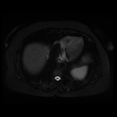 File:Adrenal myelolipoma - MRI (Radiopaedia 83249-97646 Axial STIR 4).jpg