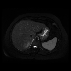 File:Adrenal myelolipoma - MRI (Radiopaedia 83249-97646 Axial STIR 9).jpg