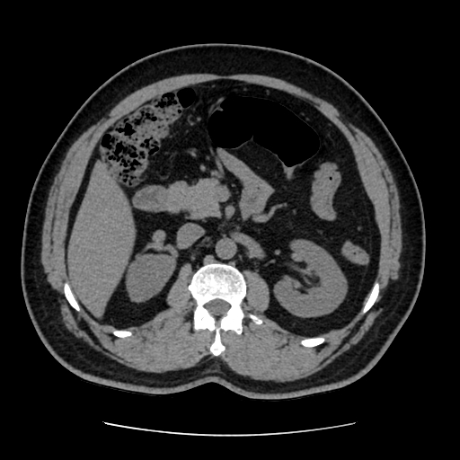 Adrenal myelolipoma and beaver tail liver (Radiopaedia 86201-102193 Axial non-contrast 188).jpg
