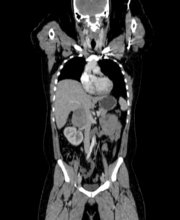 Adrenocortical carcinoma (Radiopaedia 80134-93438 Coronal C+ portal venous phase 76).jpg