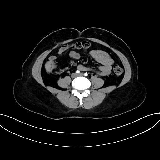 Adrenocortical carcinoma (Radiopaedia 87281-103569 Axial C+ arterial phase 55).jpg