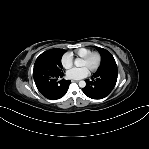 Adrenocortical carcinoma (Radiopaedia 87281-103569 Axial C+ portal venous phase 4).jpg