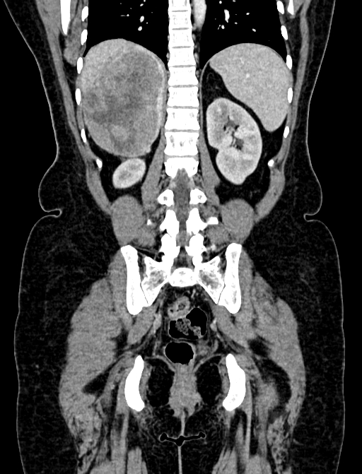 Adrenocortical carcinoma (Radiopaedia 87281-103569 Coronal C+ portal venous phase 99).jpg