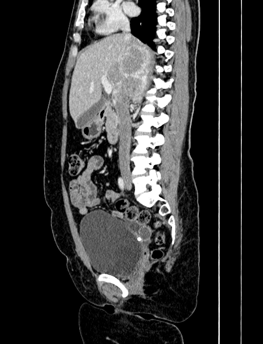 Adrenocortical carcinoma (Radiopaedia 87281-103569 Sagittal C+ portal venous phase 126).jpg