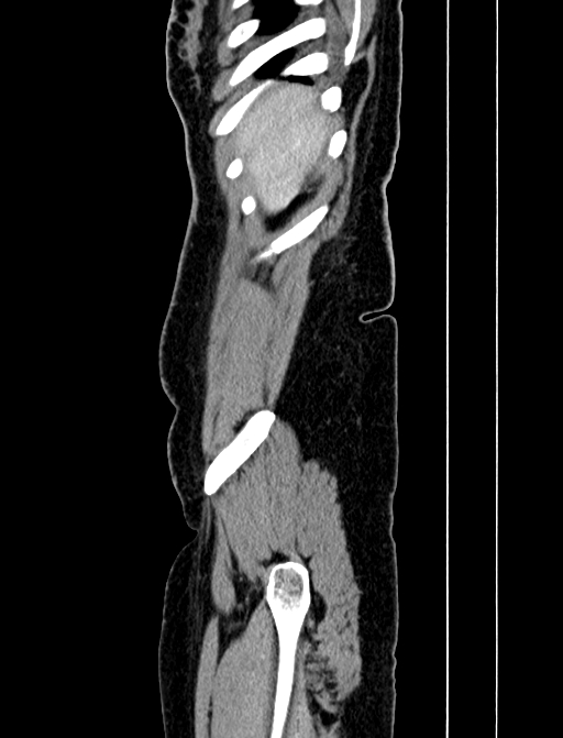 Adrenocortical carcinoma (Radiopaedia 87281-103569 Sagittal C+ portal venous phase 5).jpg